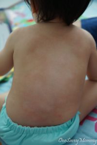 Kids Eczema Healing Naturally